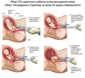 Какие существуют виды абортов