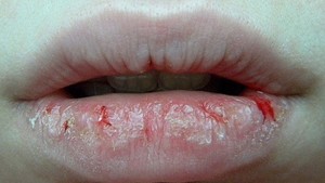 Почему сохнут губы - причины и методы решения проблемы
