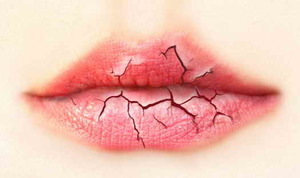 Чем лечить губы, если они очень сухие